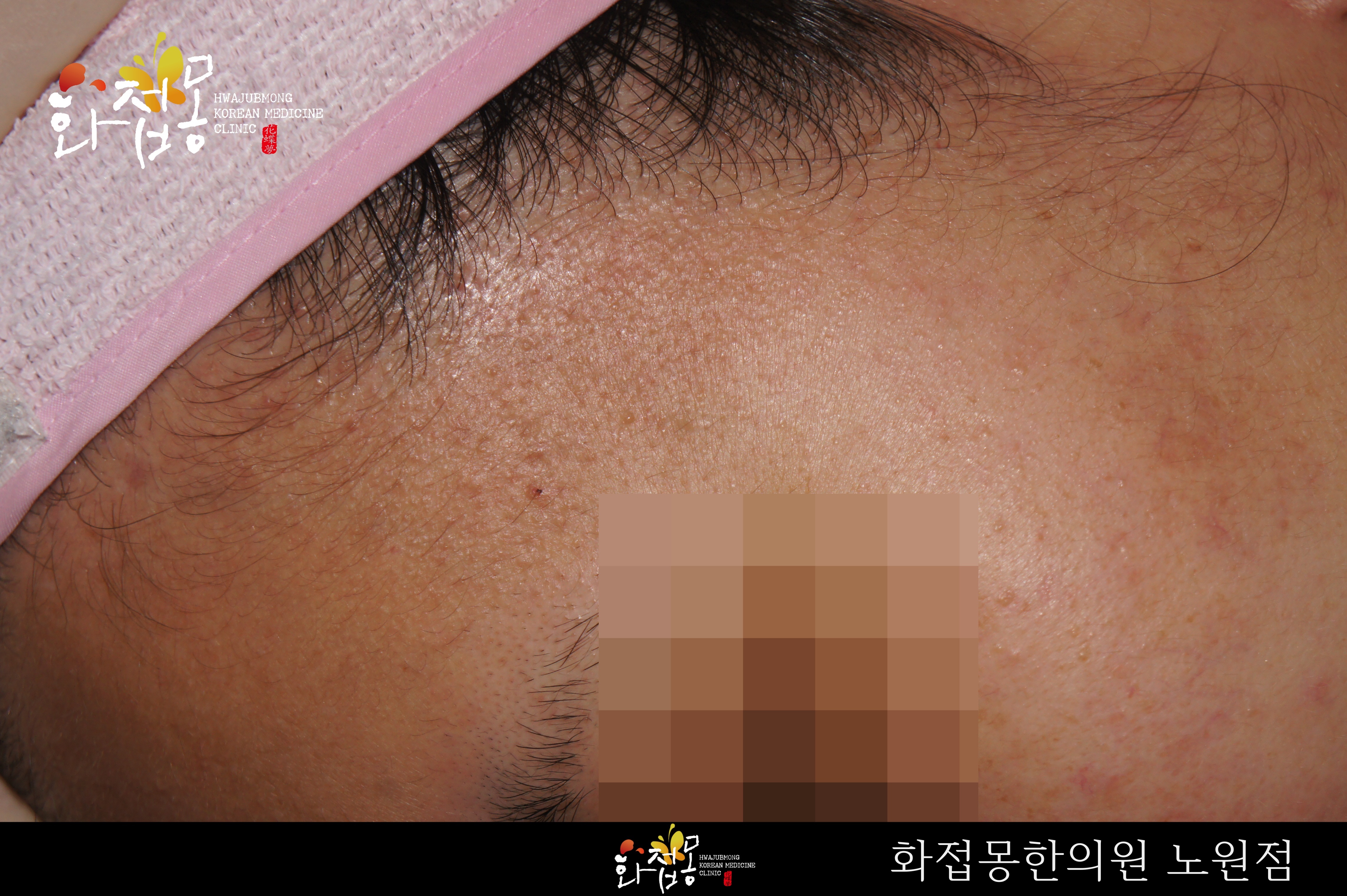 전후사진