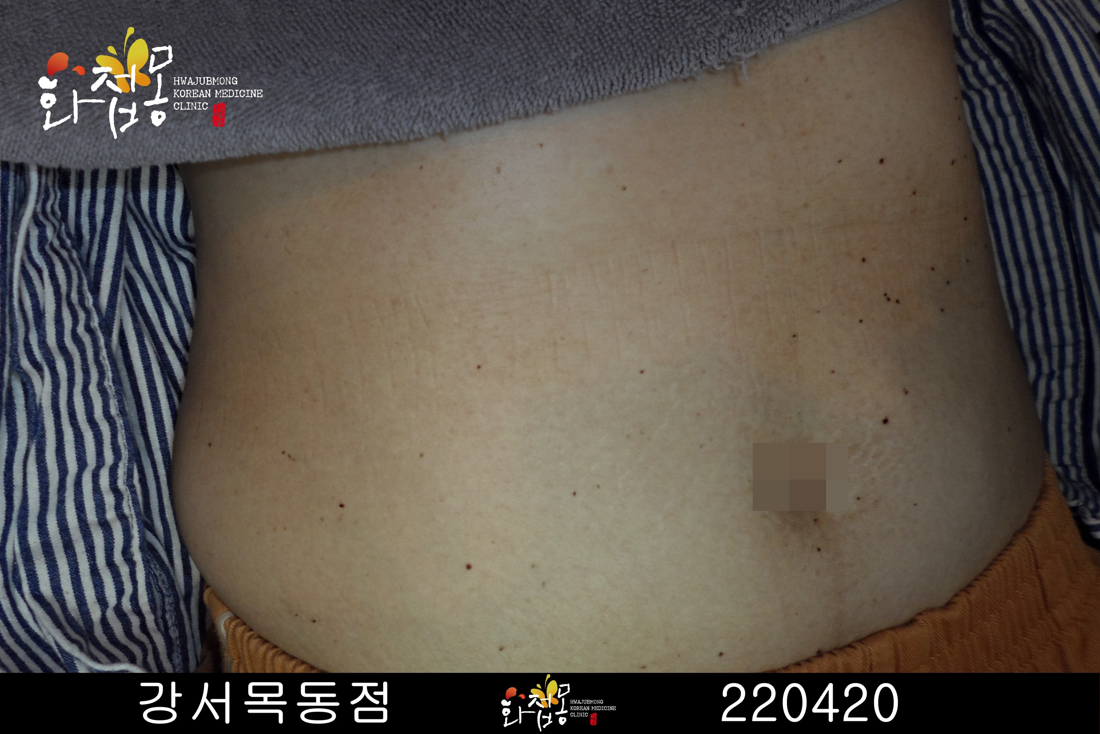 전후사진